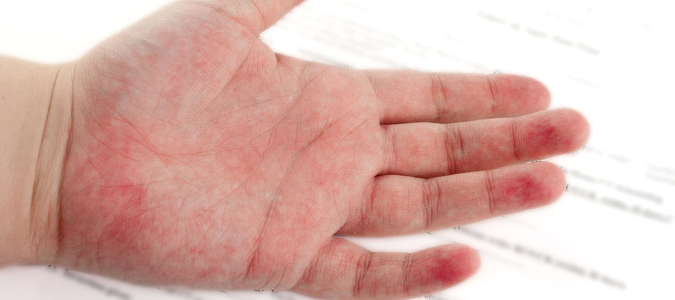 Alergic Reactions, Rashes, & Dermatitis