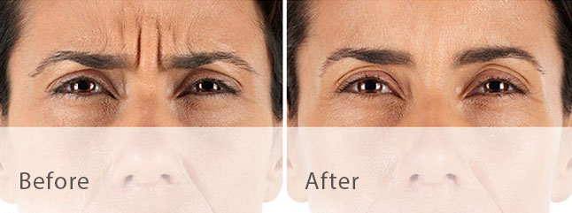 Botox and Xeomin Before and After