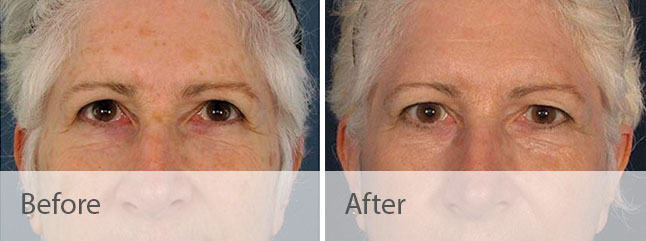 Fraxel Before and After