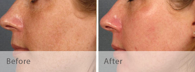 Intense Pulsed Light Photo Rejuvenation Before & After