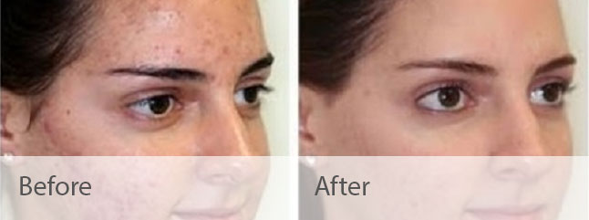 Microdermabrasion Before & After