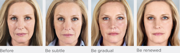 Sculptra Progression