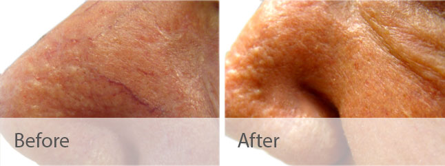 Laser Vein Treatment Before & After